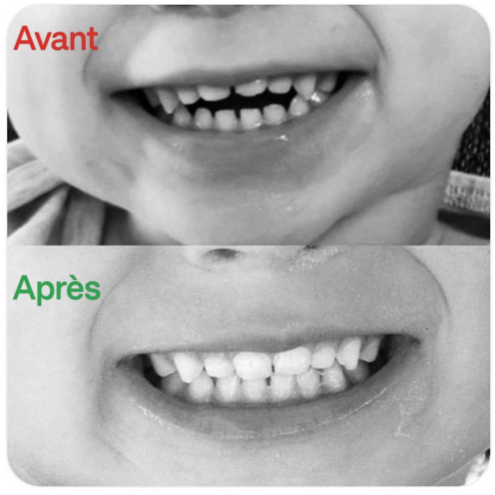 machouYou - Fini le pouce et la tétine!